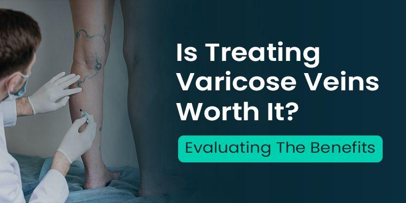 Benefits of varicose vein treatments