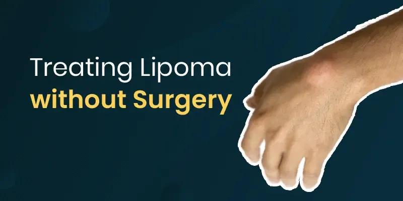 Treatment of lipoma without surgery