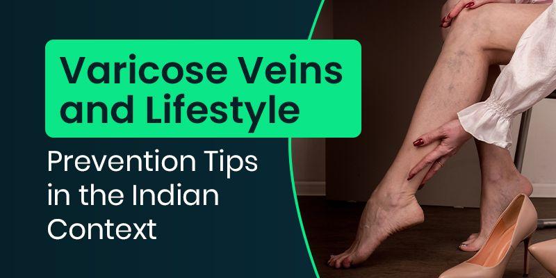 prevention for varicose vein