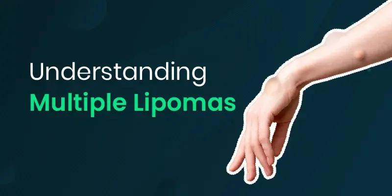 Causes of Multiple Lipomas