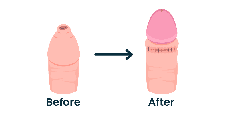 Does Circumcision Increase Size? Myths Busted