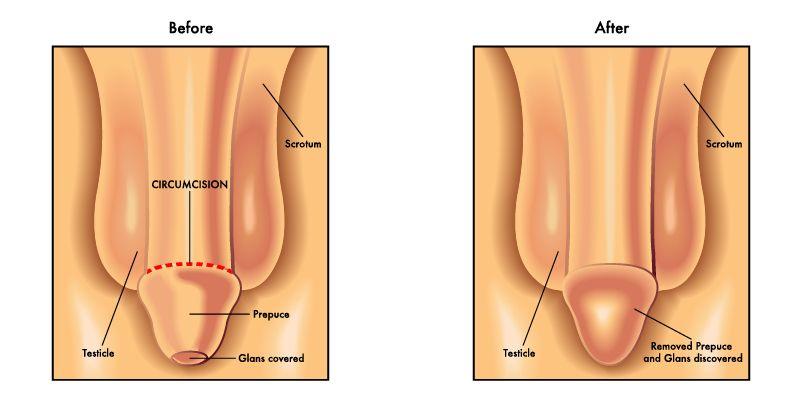 circumcision cost
