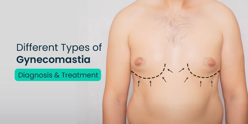 Different Types Of Gynecomastia