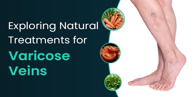 Exploring Natural Treatments for Varicose Veins