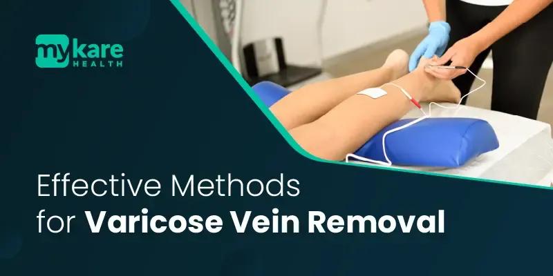 procedures for varicose vein removal