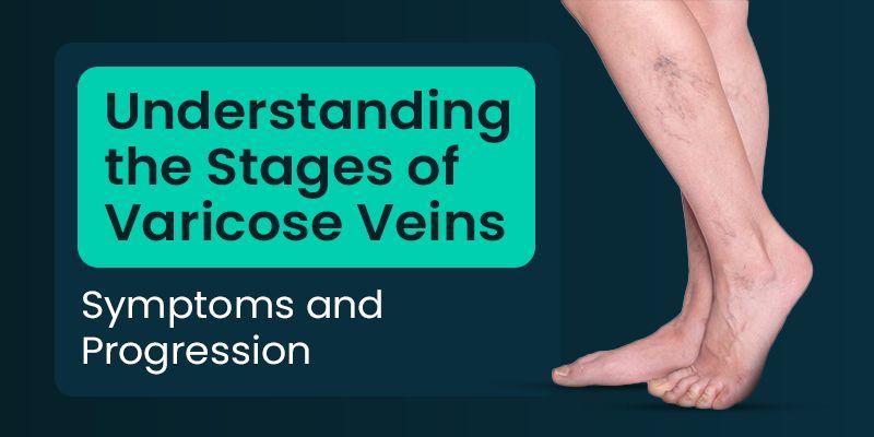 Stages of Varicose Veins