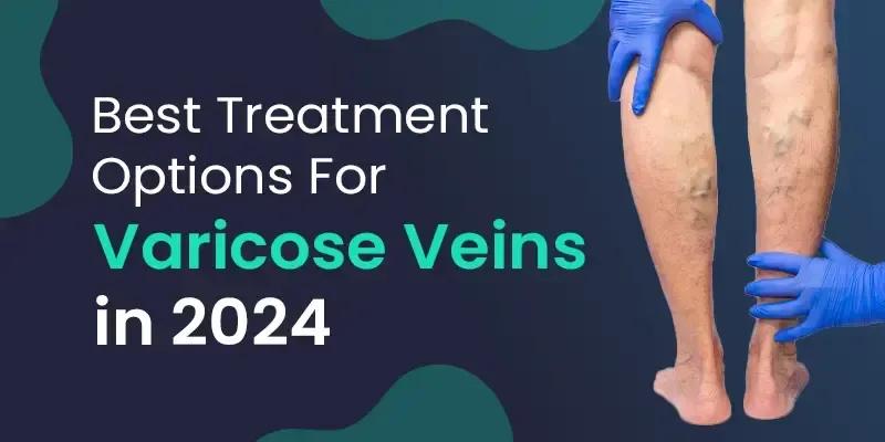 Best Treatment Options for Varicose Veins