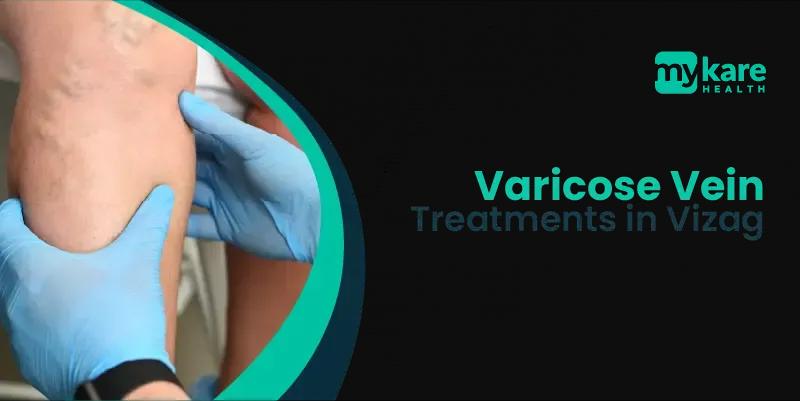 varicose vein treatments available in vizag