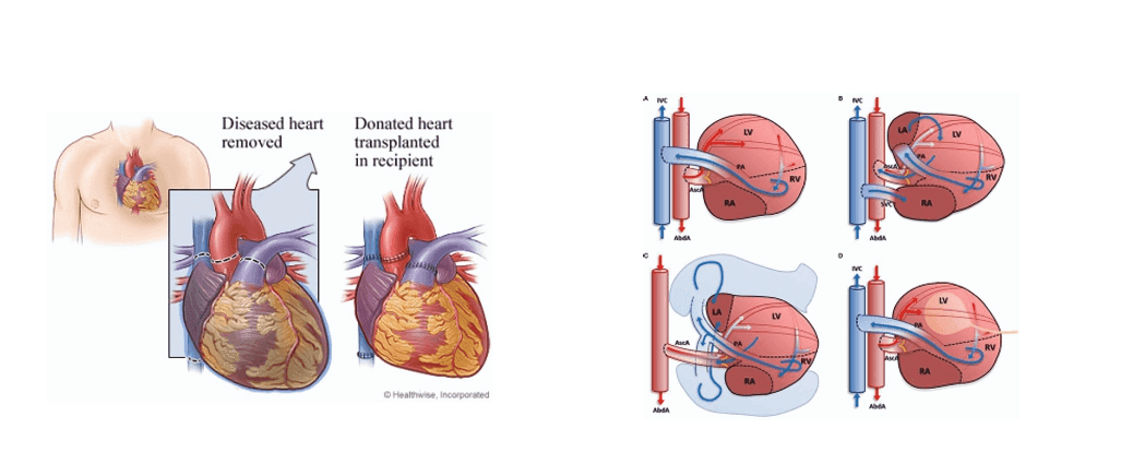 best-heart-transplant-hospital.png
